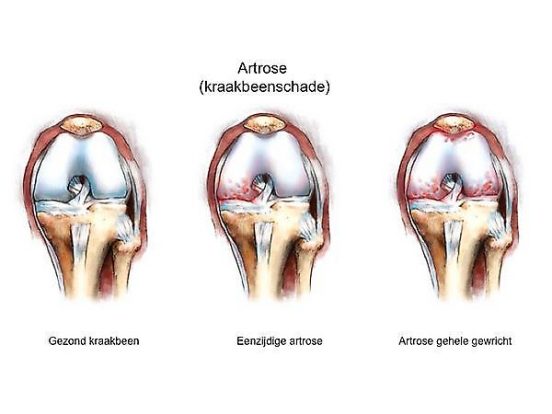 Artrose Van De Knie Medisch Spectrum Twente